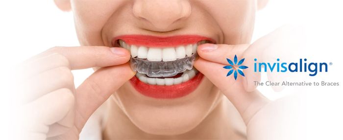 Invisalign Frankfurt